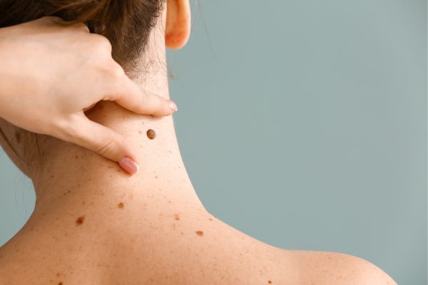 Skin Cancer Checks